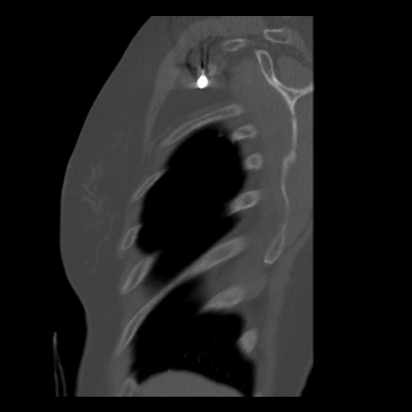 Adenocarcinoma of the lung (Radiopaedia 41015-43755 Sagittal bone window 6).jpg