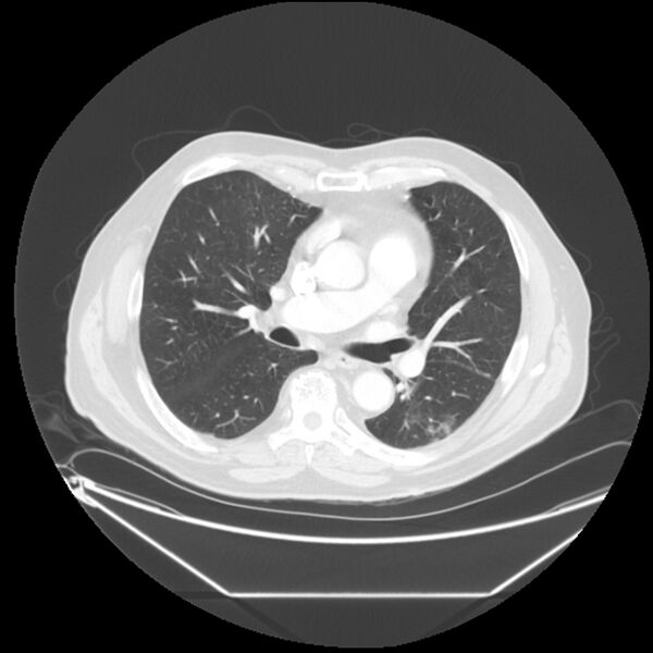 File:Adenocarcinoma of the lung (Radiopaedia 44876-48759 Axial lung window 38).jpg