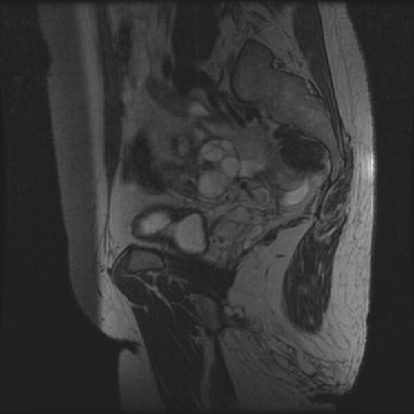 File:Adenoma malignum of the cervix (Radiopaedia 24460-24765 T2 91).jpg