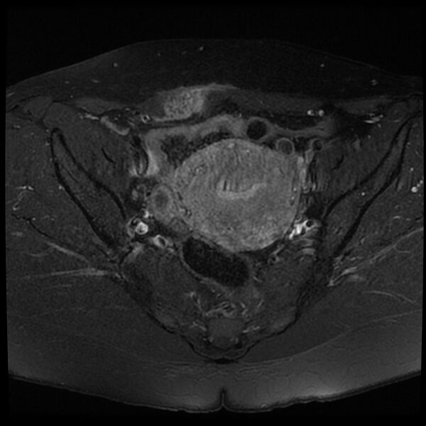 File:Adenomyosis-scar endometriosis (Radiopaedia 65863-75022 Axial T1 C+ fat sat 10).jpg