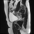 Adenomyosis - ovarian endometriomas (Radiopaedia 67031-76350 Sagittal T2 4).jpg