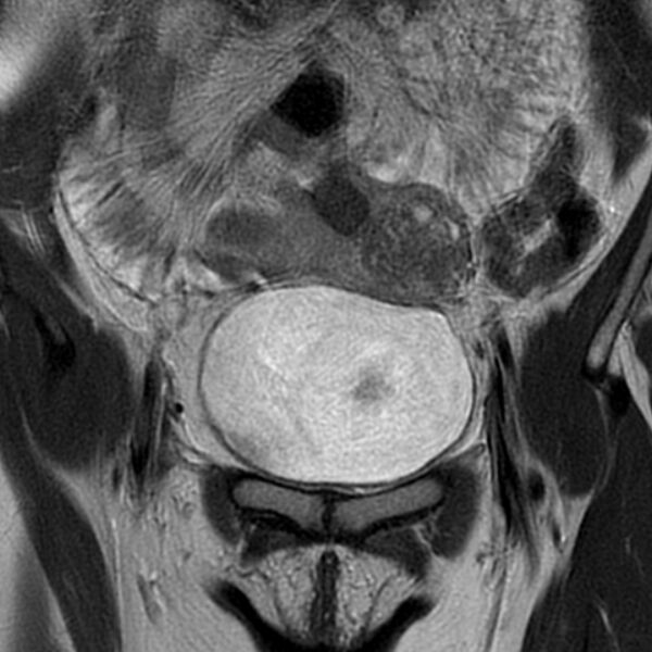 File:Adenomyosis within a septate uterus (Radiopaedia 69963-79981 Coronal T2 4).jpg