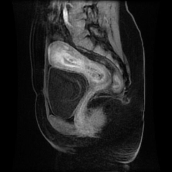 File:Adenomyosis within a septate uterus (Radiopaedia 69963-79981 Sagittal LAVA-Dyn 19).jpg