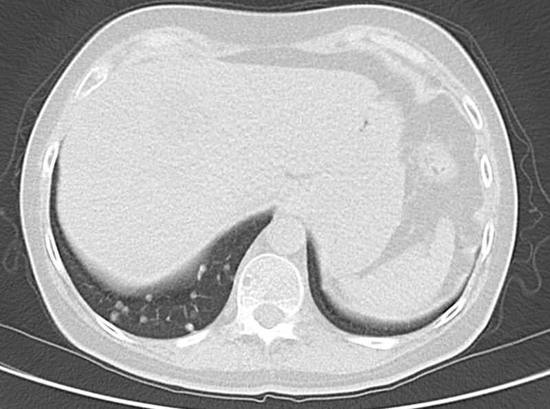 File:Adenosquamous lung carcinoma (Radiopaedia 22035-22030 lung window 53).jpg