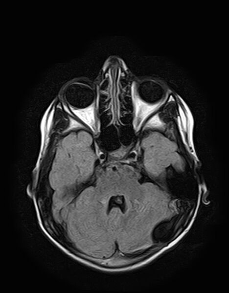 File:Aicardi syndrome (Radiopaedia 66029-75205 Axial FLAIR 8).jpg