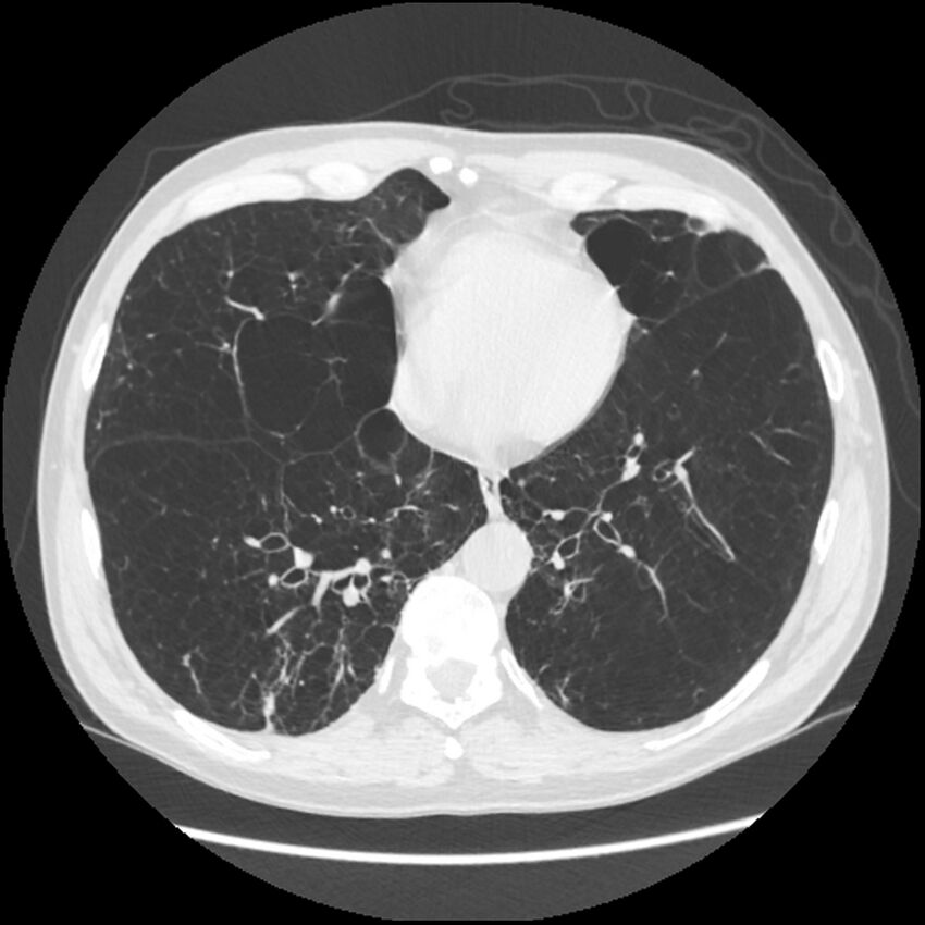 Alpha-1-antitrypsin deficiency (Radiopaedia 40993-43722 Axial lung window 165).jpg