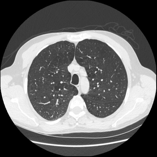 File:Alpha-1-antitrypsin deficiency (Radiopaedia 40993-43722 Axial lung window 59).jpg