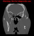 Ameloblastoma (Radiopaedia 13276-13280 Coronal non-contrast 15).jpg