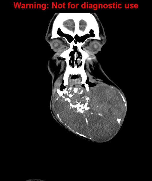 File:Ameloblastoma (Radiopaedia 33126-34164 D 15).jpg