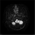 Amnestic syndrome secondary to hypoxic brain injury (Radiopaedia 24743-25004 DWI 5).jpg
