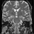 Amnestic syndrome secondary to hypoxic brain injury (Radiopaedia 24743-25004 F 9).jpg