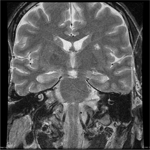 File:Amnestic syndrome secondary to hypoxic brain injury (Radiopaedia 24743-25004 F 9).jpg