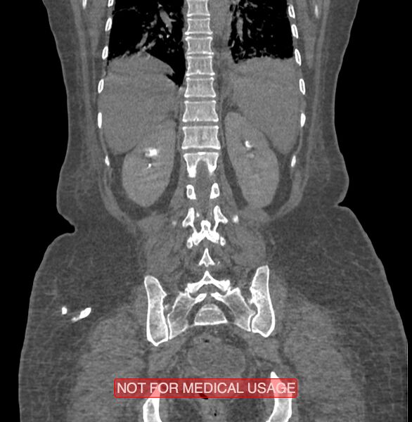 File:Amoebic enterocolitis with liver abscess (Radiopaedia 35100-36609 B 155).jpg