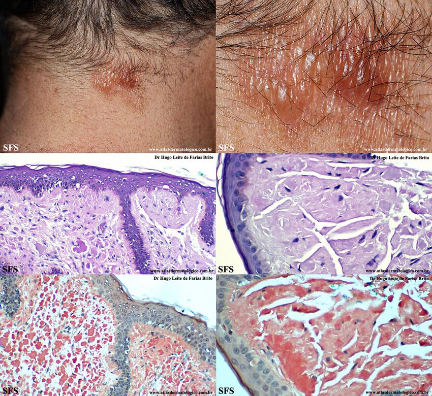 Amyloidosis-Nodular Amyloidosis (Dermatology Atlas 15).jpg