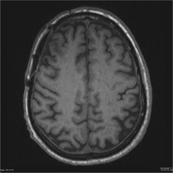 File:Anaplastic meningioma with recurrence (Radiopaedia 34452-35788 Axial T1 103).jpg