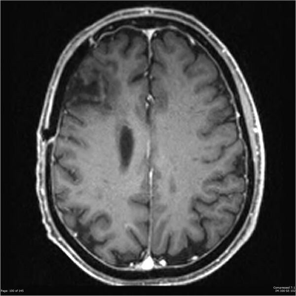 File:Anaplastic meningioma with recurrence (Radiopaedia 34452-35788 Axial T1 C+ 100).jpg