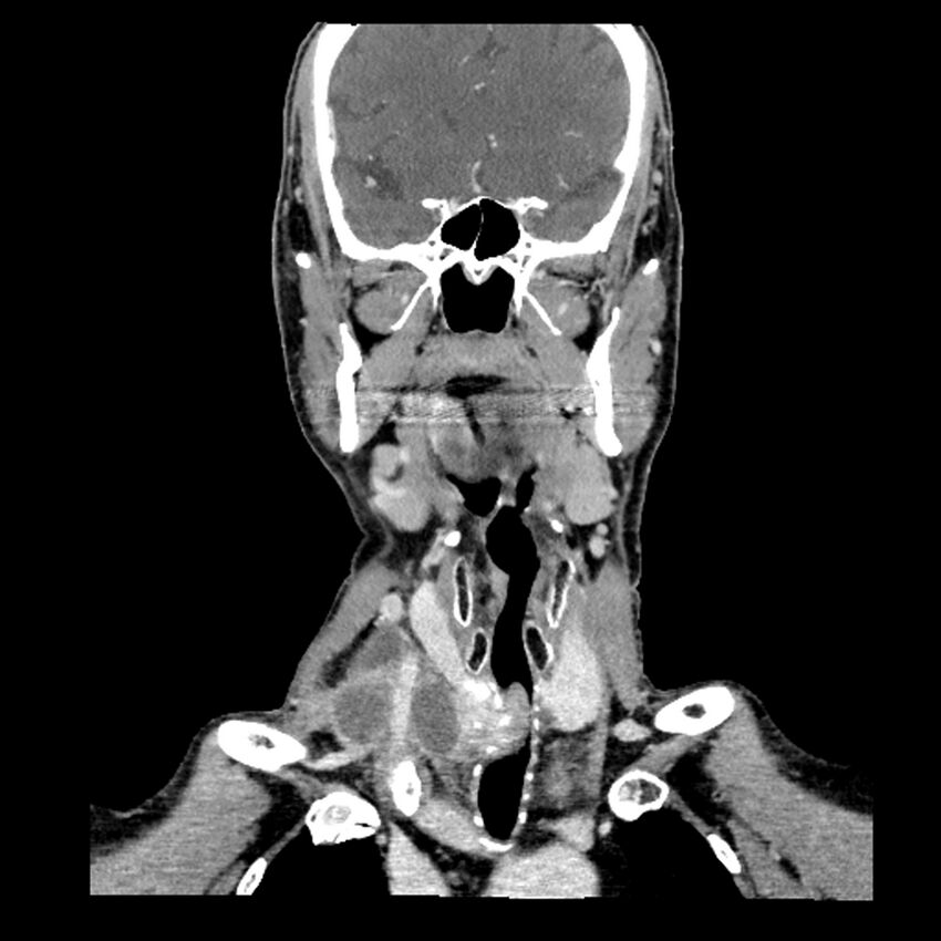 Anaplastic thyroid carcinoma (Radiopaedia 79087-92034 A 54).jpg