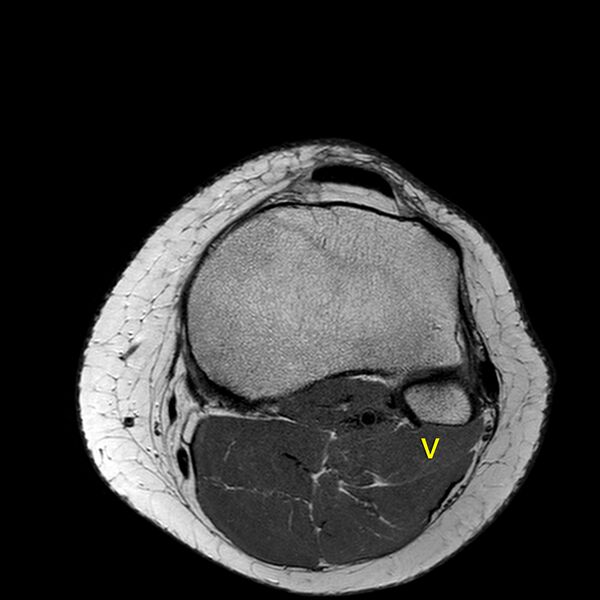 File:Anatomy Quiz (MRI knee) (Radiopaedia 43478-46866 A 23).jpeg