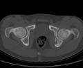 Aneurysmal bone cyst of ischium (Radiopaedia 25957-26094 Axial bone window 62).png