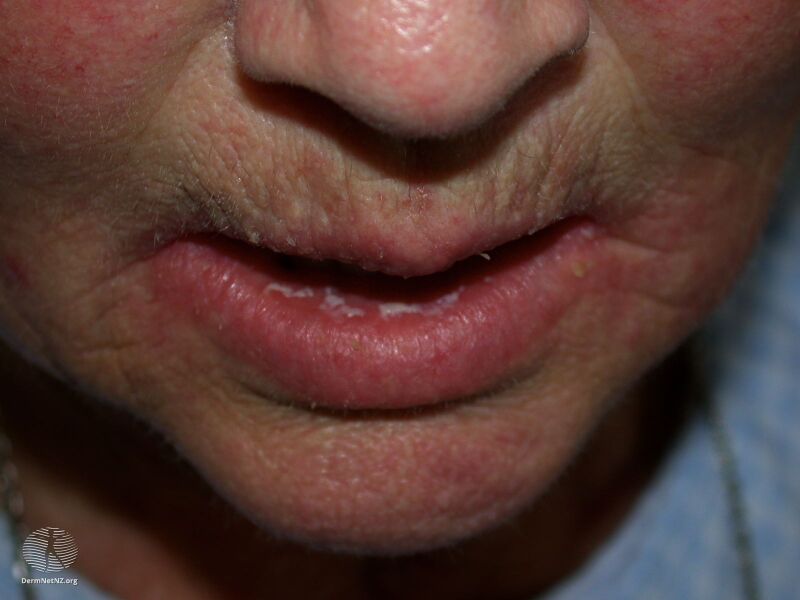 File:Angular cheilitis (DermNet NZ 1282-big).jpg