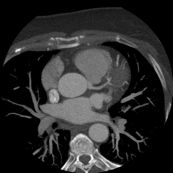 File:Anomalous origin of left circumflex artery from right coronary sinus (Radiopaedia 72563-83117 A 43).jpg