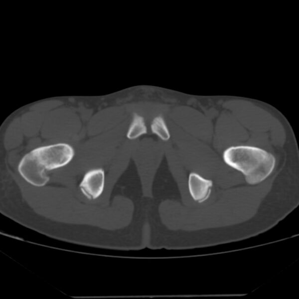 File:Anterior inferior iliac spine avulsion fracture (Radiopaedia 49469-54627 Axial bone window 51).jpg