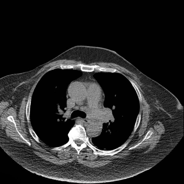 File:Aortic arch false aneurysm (Radiopaedia 14667-14587 Axial non-contrast 19).jpg
