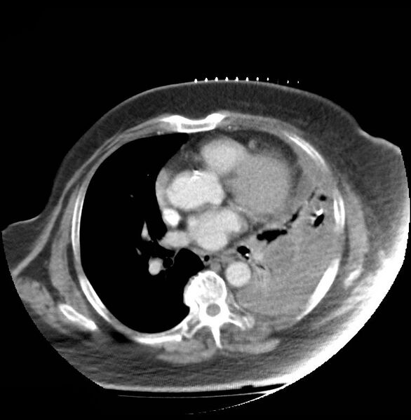 File:Aortic arch false aneurysm (Radiopaedia 14667-14588 A 14).jpg