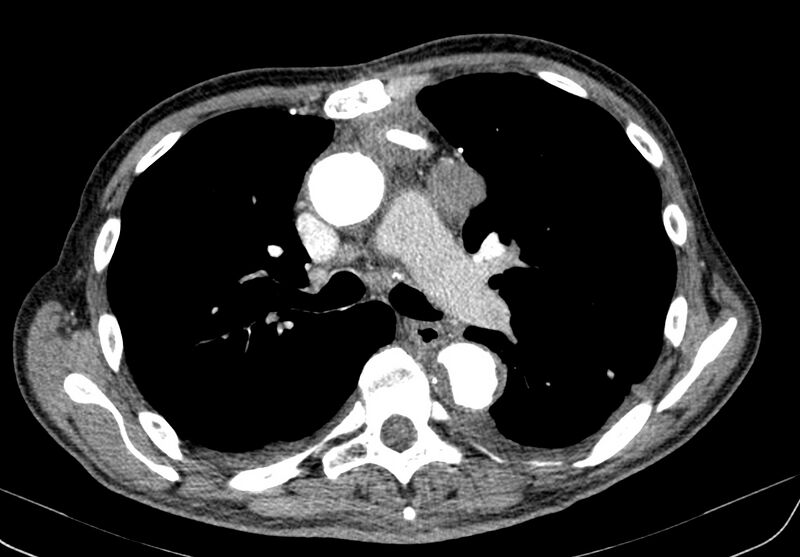 File:Aortic arch saccular aneurysm (Radiopaedia 19430-19457 B 14).jpg