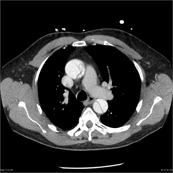 File:Aortic dissection- Stanford A (Radiopaedia 37759-39664 A 22).jpg