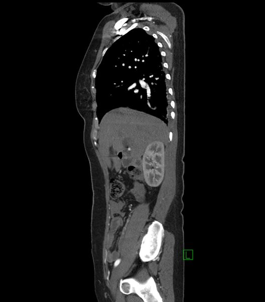 File:Aortic dissection with renal ischemia (Radiopaedia 76573-88338 D 3).jpg