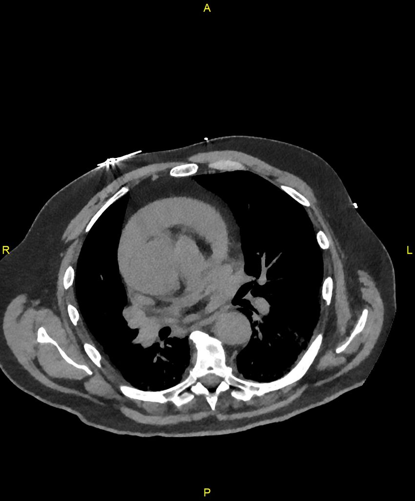 Aortic rupture (Radiopaedia 88822-105594 Axial non-contrast 105).jpg