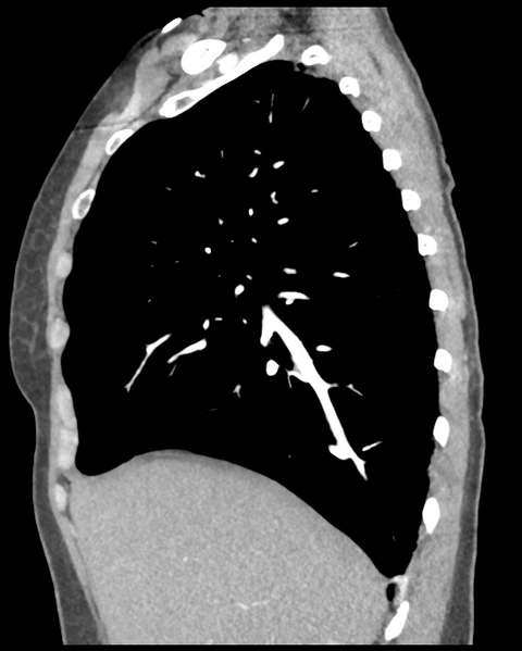 File:Aortic valve non-coronary cusp thrombus (Radiopaedia 55661-62189 D 37).png