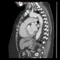 Aortic valve stenosis (Radiopaedia 14480-14423 B 7).jpg