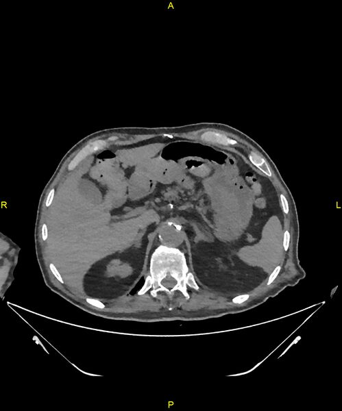 File:Aortoenteric fistula (Radiopaedia 84308-99603 Axial non-contrast 71).jpg