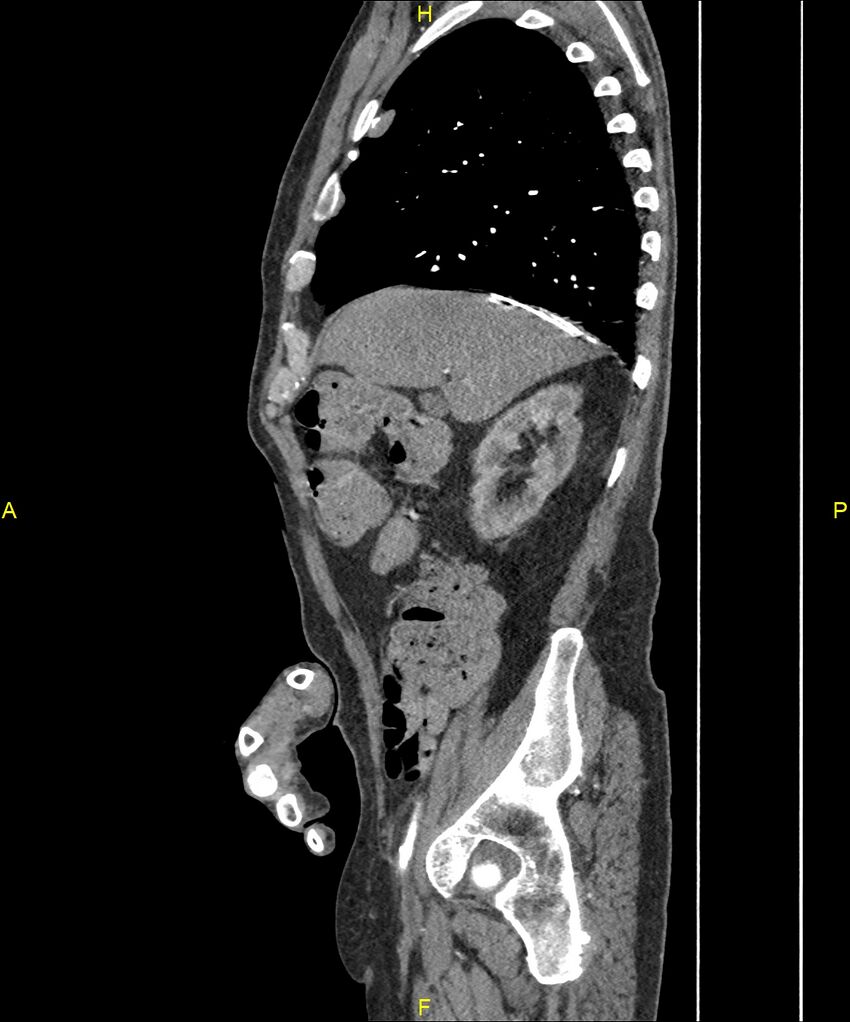 Aortoenteric fistula (Radiopaedia 84308-99603 C 98).jpg