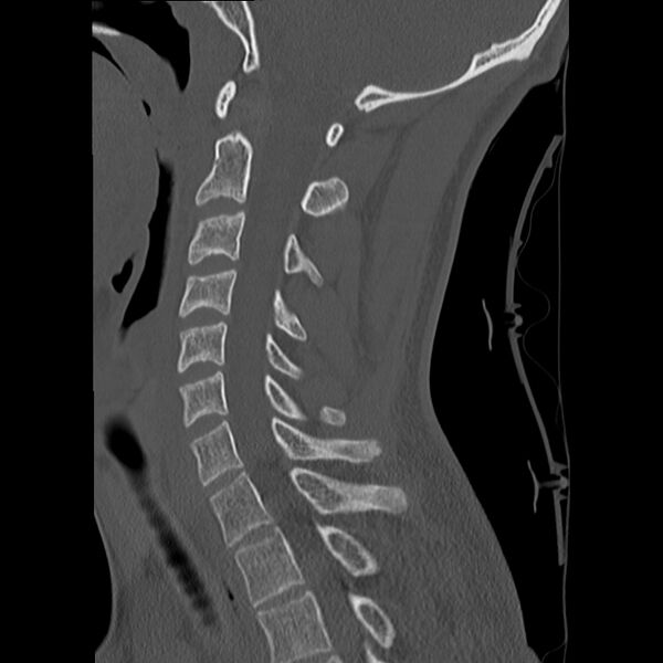 File:Apical pneumothorax on cervical spine CT (Radiopaedia 45343-49368 Sagittal bone window 19).jpg