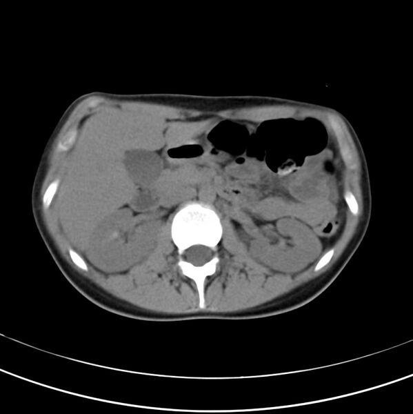 File:Appendicitis and incidental bicornuate uterus (Radiopaedia 22833-22853 Axial non-contrast 16).jpg