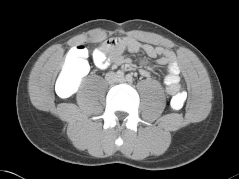 File:Appendicitis and incidental foregut duplication cyst (Radiopaedia 52962-58916 A 43).jpg