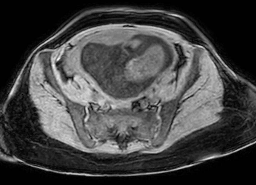 Appendicitis in gravida (MRI) (Radiopaedia 89433-106395 Axial DIXON 112).jpg