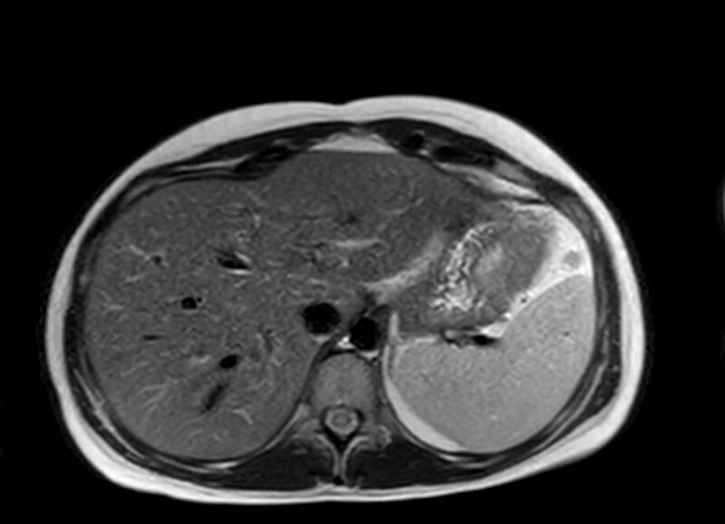 File:Appendicitis in gravida (MRI) (Radiopaedia 89433-106395 Axial T2 10).jpg