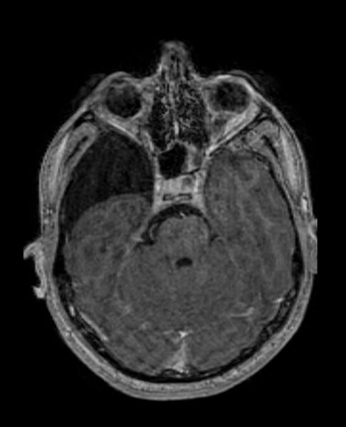 File:Arachnoid cyst- extremely large (Radiopaedia 68741-78451 Axial T1 C+ 27).jpg