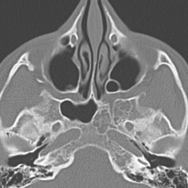 File:Arrested pneumatization of the sphenoid (Radiopaedia 10700-11172 Axial non-contrast 6).jpg