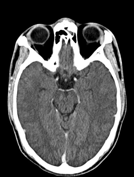 File:Arrow injury to the face (Radiopaedia 73267-84011 Axial C+ delayed 48).jpg