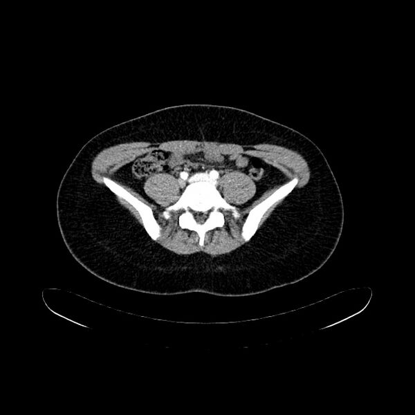 File:Arteriovenous malformation - thigh (Radiopaedia 14948-14883 Axial 92).jpg