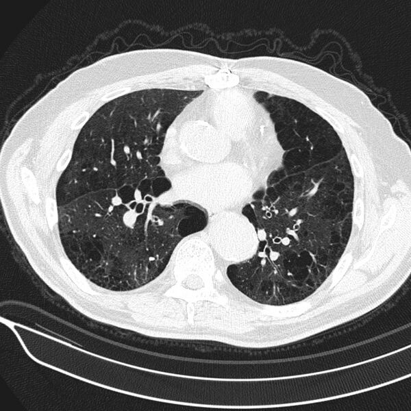 File:Aspergilloma (Radiopaedia 24521-24804 Axial lung window 14).jpg