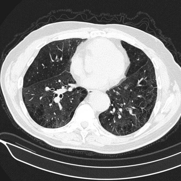 File:Aspergilloma (Radiopaedia 24521-24804 Axial lung window 16).jpg