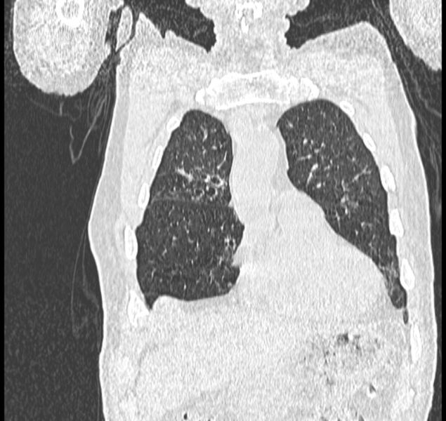 File:Aspergilloma (Radiopaedia 44592-48327 Coronal lung window 22).jpg