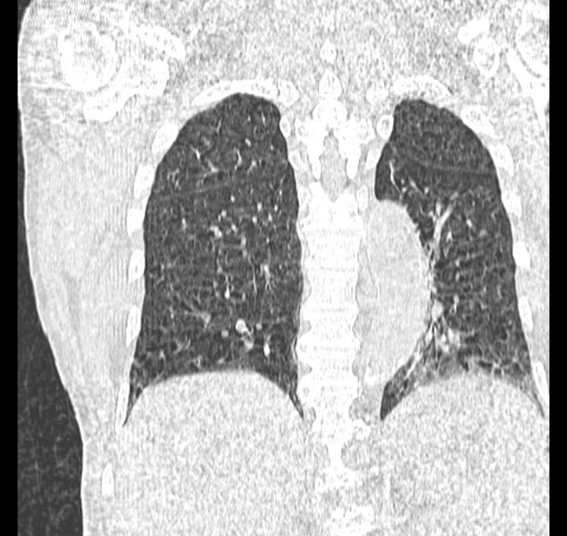 File:Aspergilloma (Radiopaedia 44592-48327 Coronal lung window 95).jpg