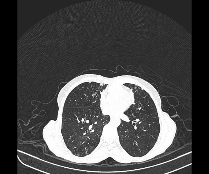 File:Aspergillomas (Radiopaedia 66779-76110 Axial lung window 28).jpg